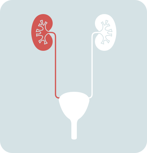 Radical nephroureterectomy graphic